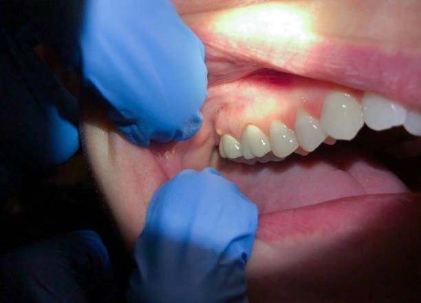 Best Tooth Infection Emergency Dentist  in Brownsville, FL